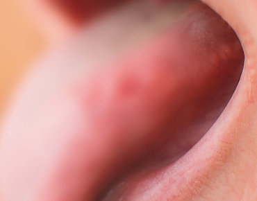 Ablagerung auf der Zunge