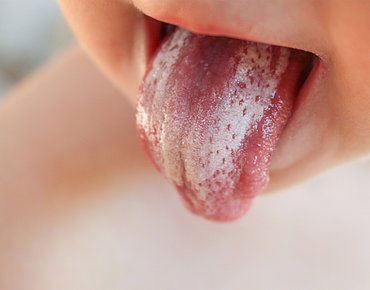 Ablagerung auf Zunge